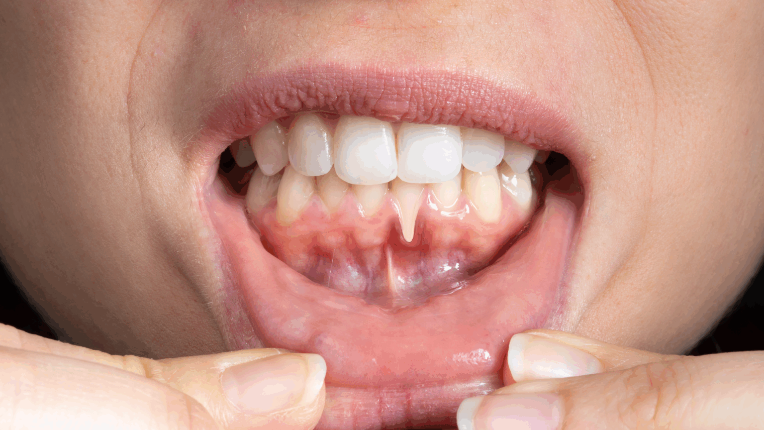 Hidden Signs of Gum Disease You Shouldn’t Ignore