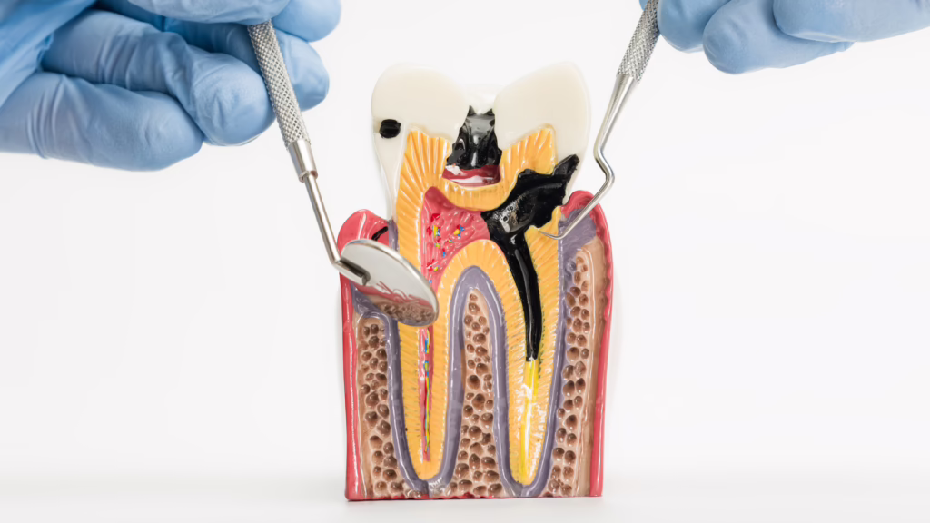 Do Antibiotics Cure a Tooth Infection?