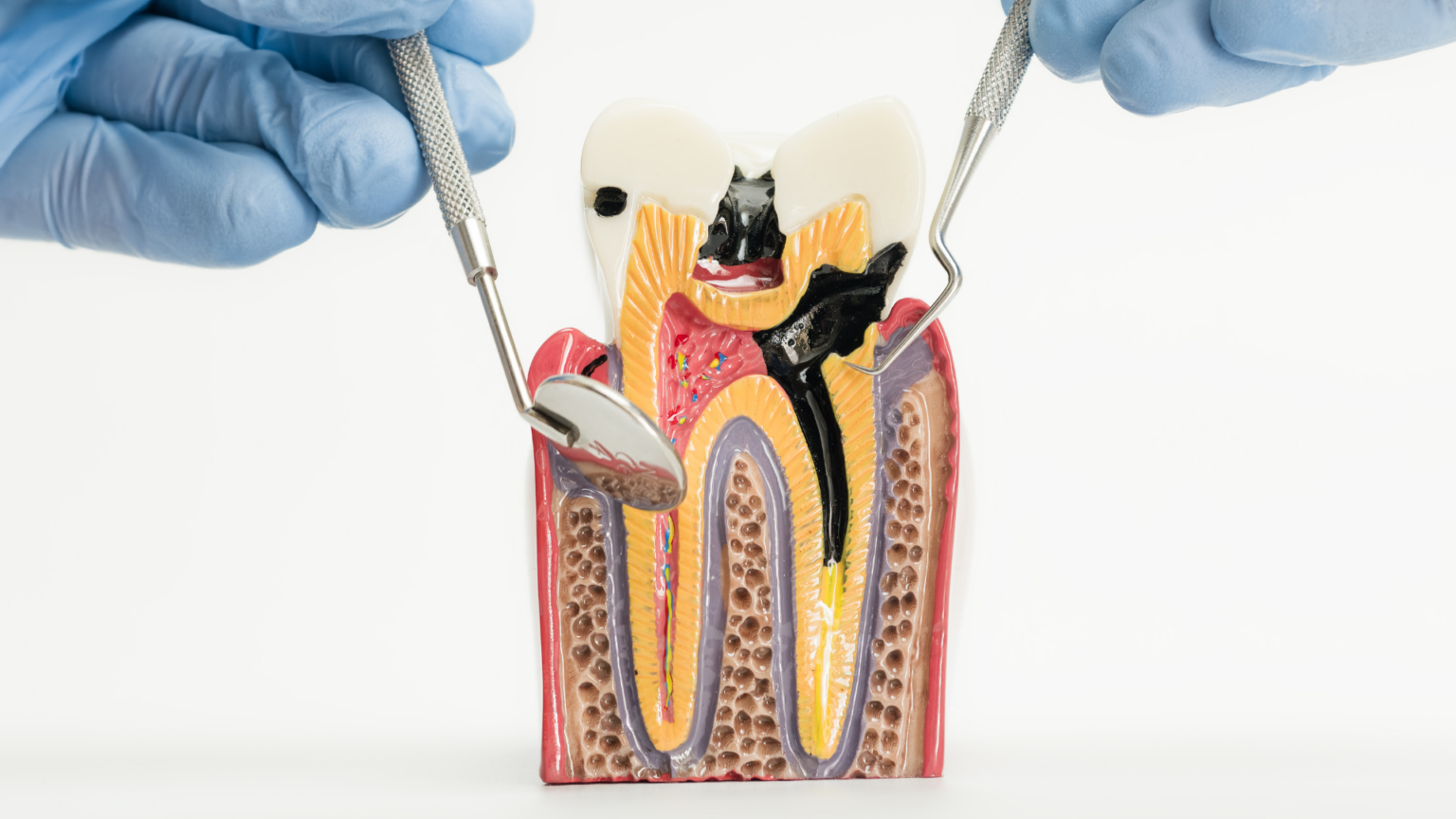 Do Antibiotics Cure a Tooth Infection?